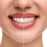 White Diet and Teeth Whitening
