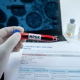 Mpox Viruela del mono en California Síntomas, Transmisión y Prevención