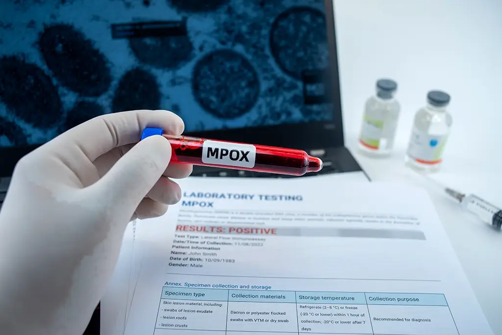 Mpox-Viruela-del-mono-en-California-Sintomas-Transmision-y-Prevencion.webp