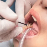 Preventive Resin Restoration