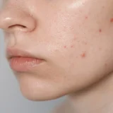 can collagen cause acne