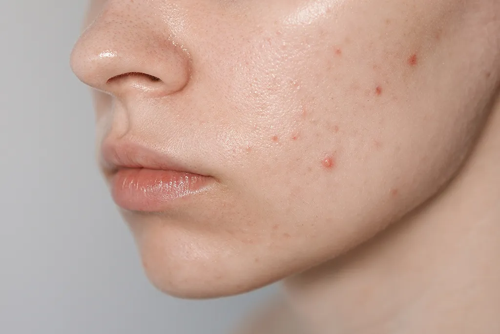 can-collagen-cause-acne.webp